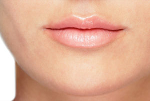 Lip Augmentation