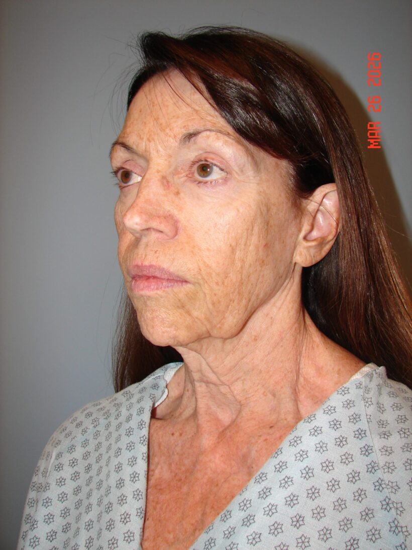 Before Procedure