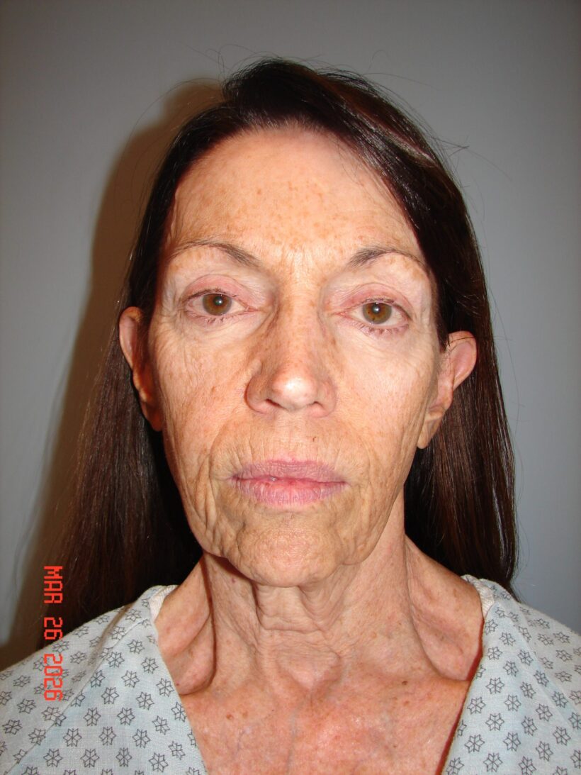 Before Procedure