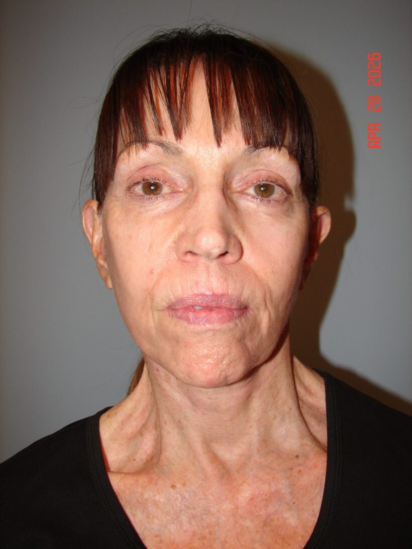 After Procedure