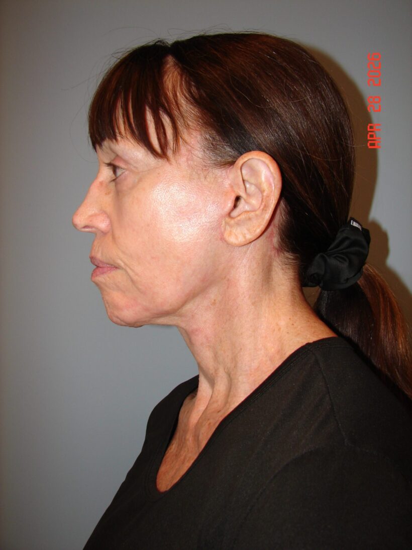 After Procedure