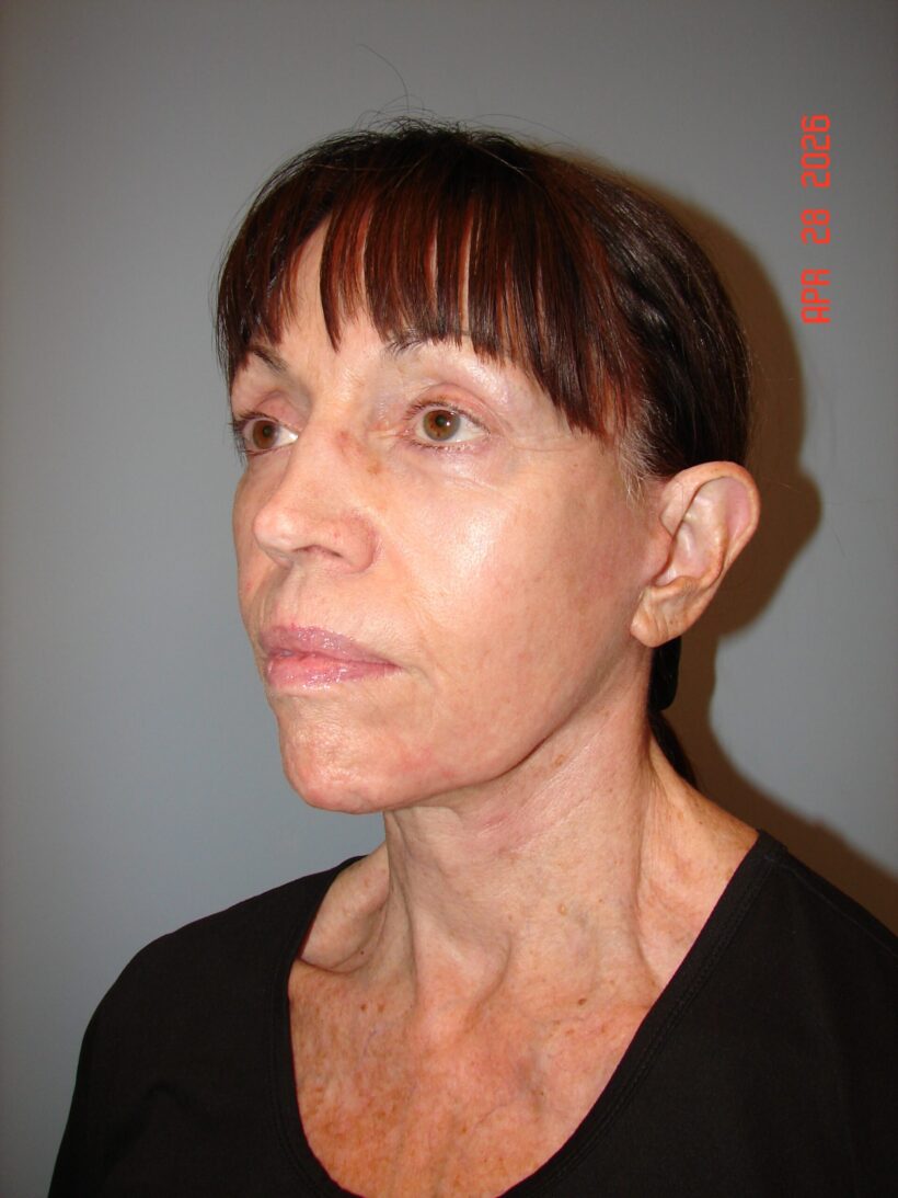 After Procedure
