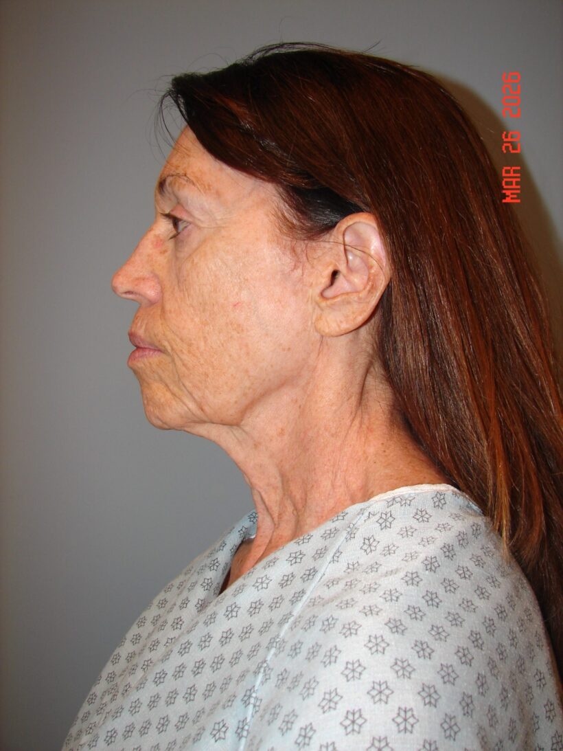 Before Procedure